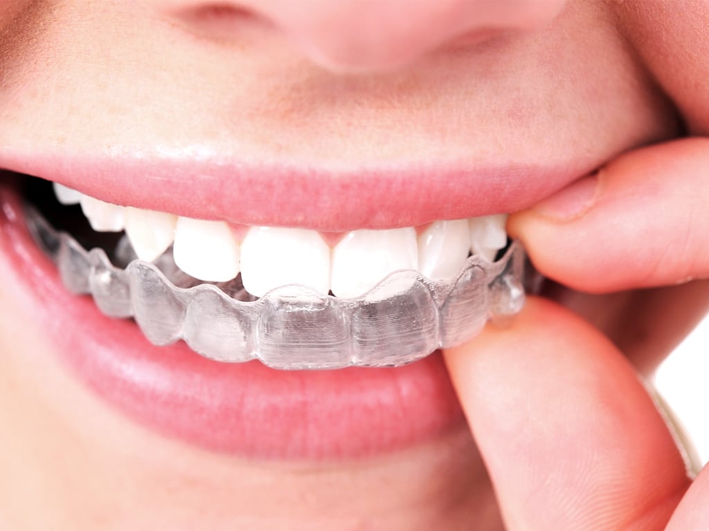 Featured image for “Ask Your Corpus Christi Dentist: What’s the difference between Invisalign and Metal Braces?”