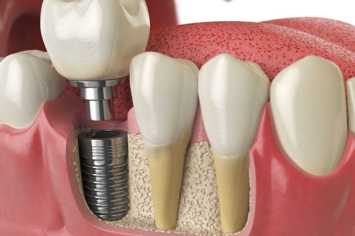 Dental Implants Worth It Pros, Cons, and Long-Term Results
