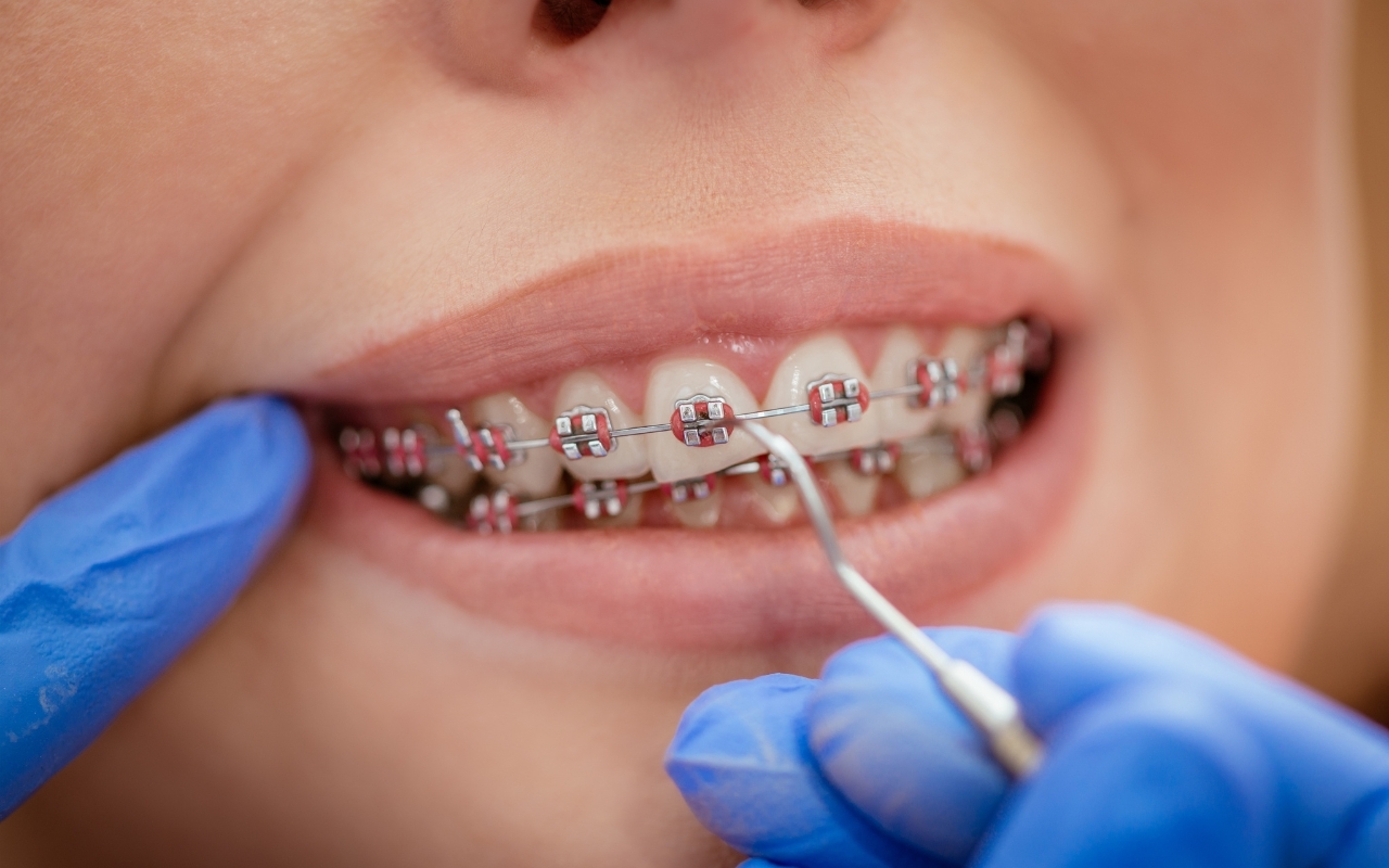Decorating Your Braces for the Holidays: Fun Colors and Smart Care Tips