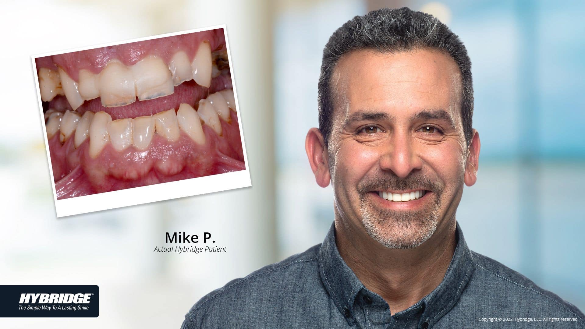 before-after_smile_gallery_w-bkgds_mike-p