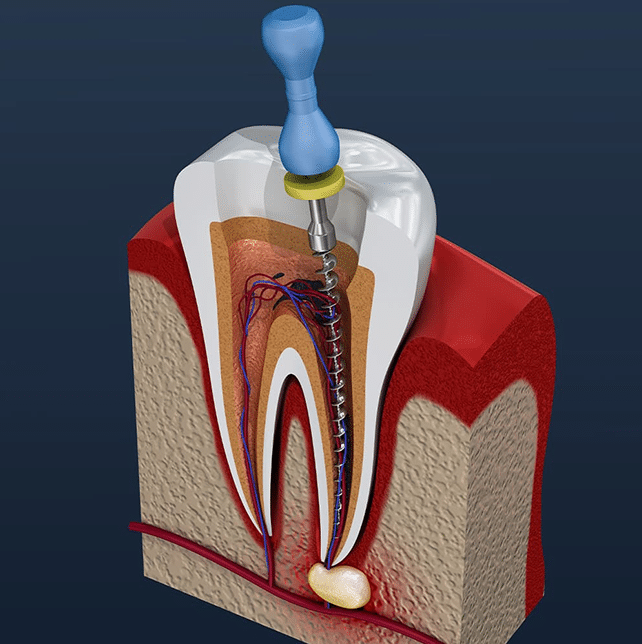 img-Root-Canal