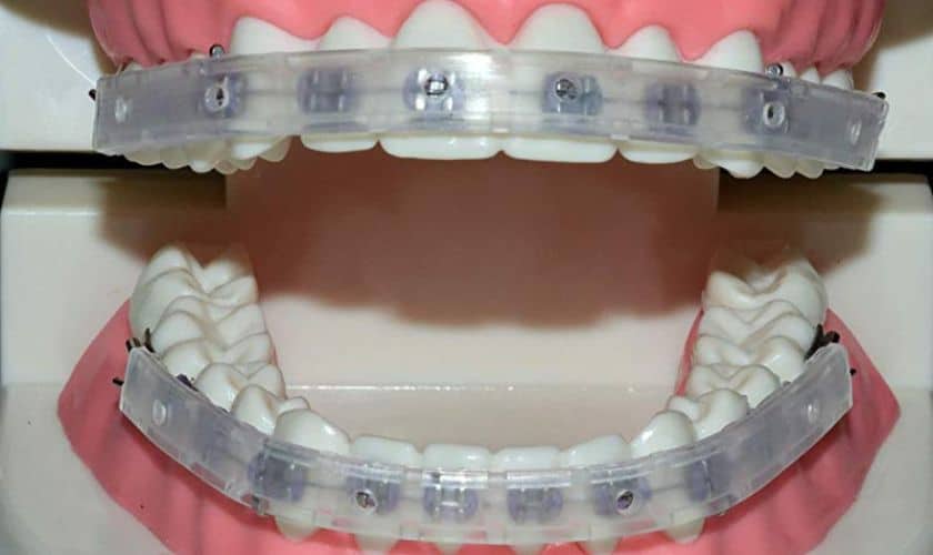 Mouthguard for braces