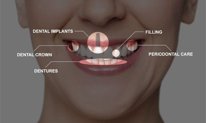 Full Mouth Restoration Treatment
