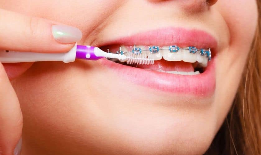 Featured image for “Top 7 Tips on Caring for Your Braces”