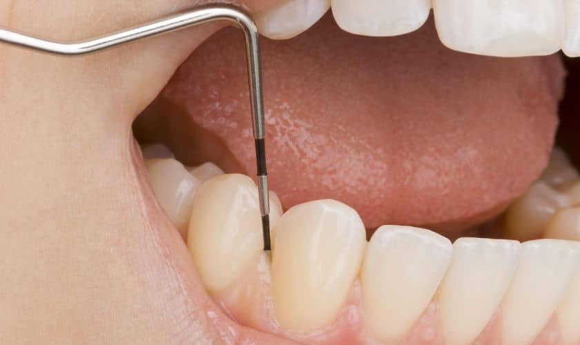 Featured image for “A Comprehensive Guide On How To Prepare For A Periodontal Examination”
