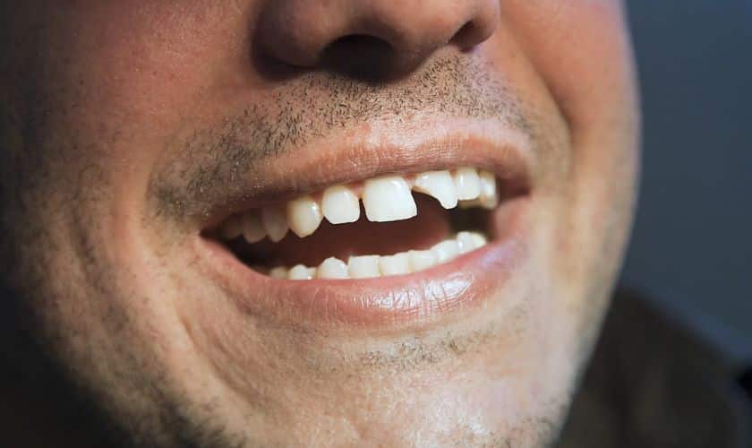 Featured image for “5 Surprising Dangers of Unaddressed Chipped Teeth”