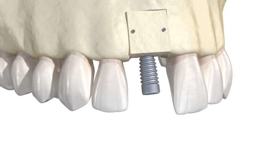 Bone Grafting Corpus Christi