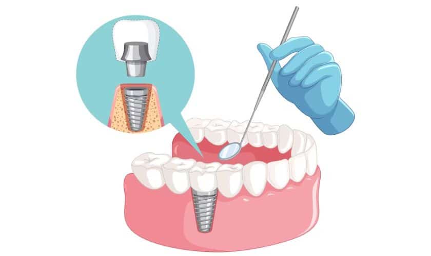Featured image for “Recovering from Dental Implant Surgery: What to Expect in Corpus Christi, TX”