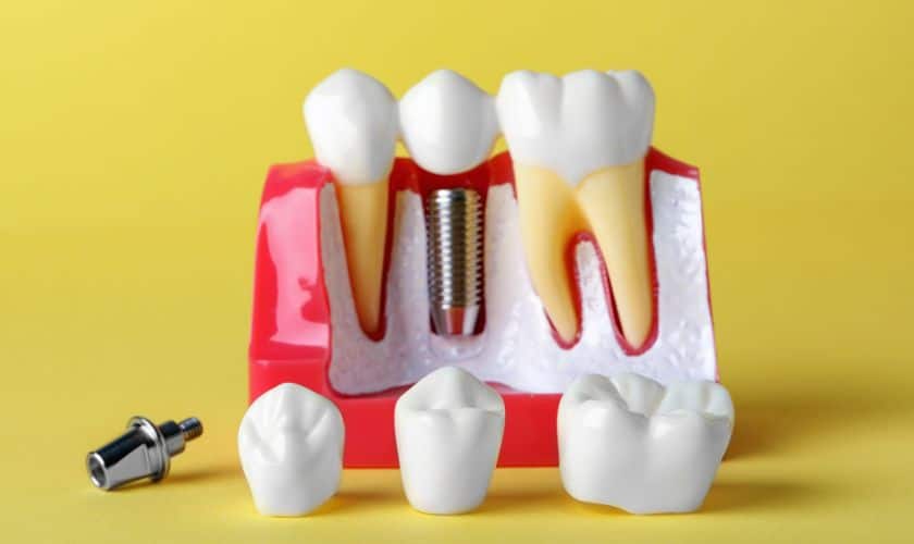 Implant Dentistry in corpus christi