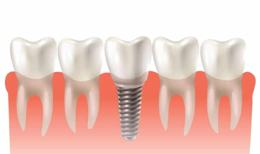 Featured image for “Choosing the Right Provider for Implants Dentistry in Corpus Christi, TX”
