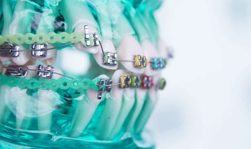 A Simple Breakdown Of The 3 Different Phases Of Orthodontic