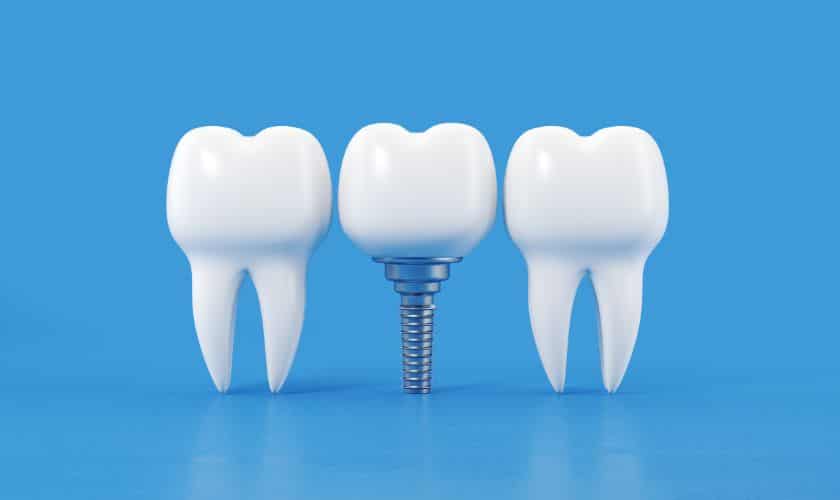 Dental Implants Corpus Christi