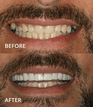 Before and after dental treatment showing improved teeth alignment and whitening results.