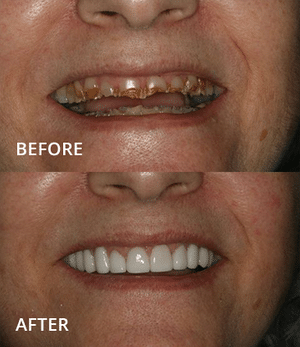 Before and after dental implants showing improved smile and tooth appearance.