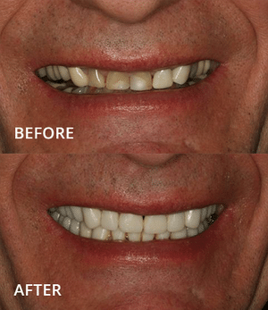 Before and after comparison of smile transformation showing improved teeth alignment and appearance.