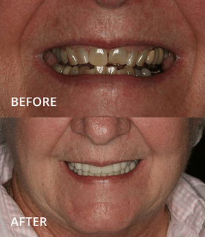 Before and after dental implant transformation showing improved smile and tooth alignment.
