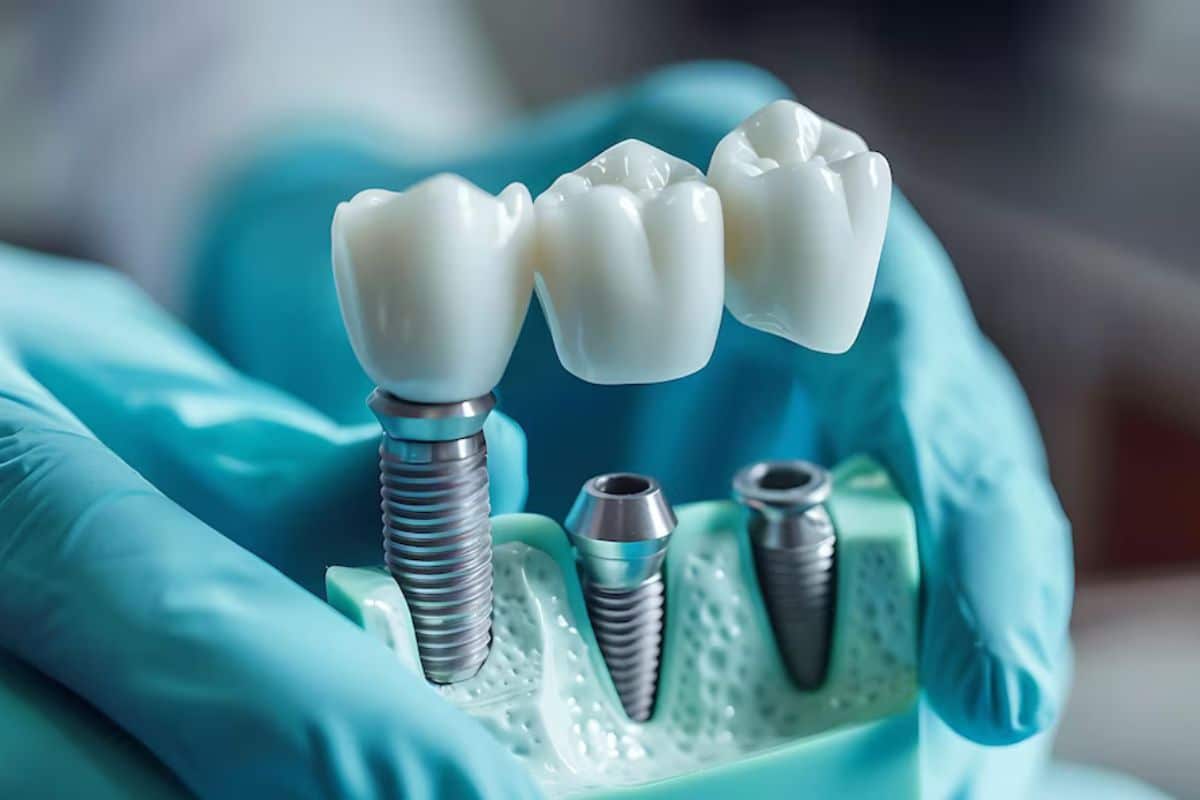 Benefit of dental implants