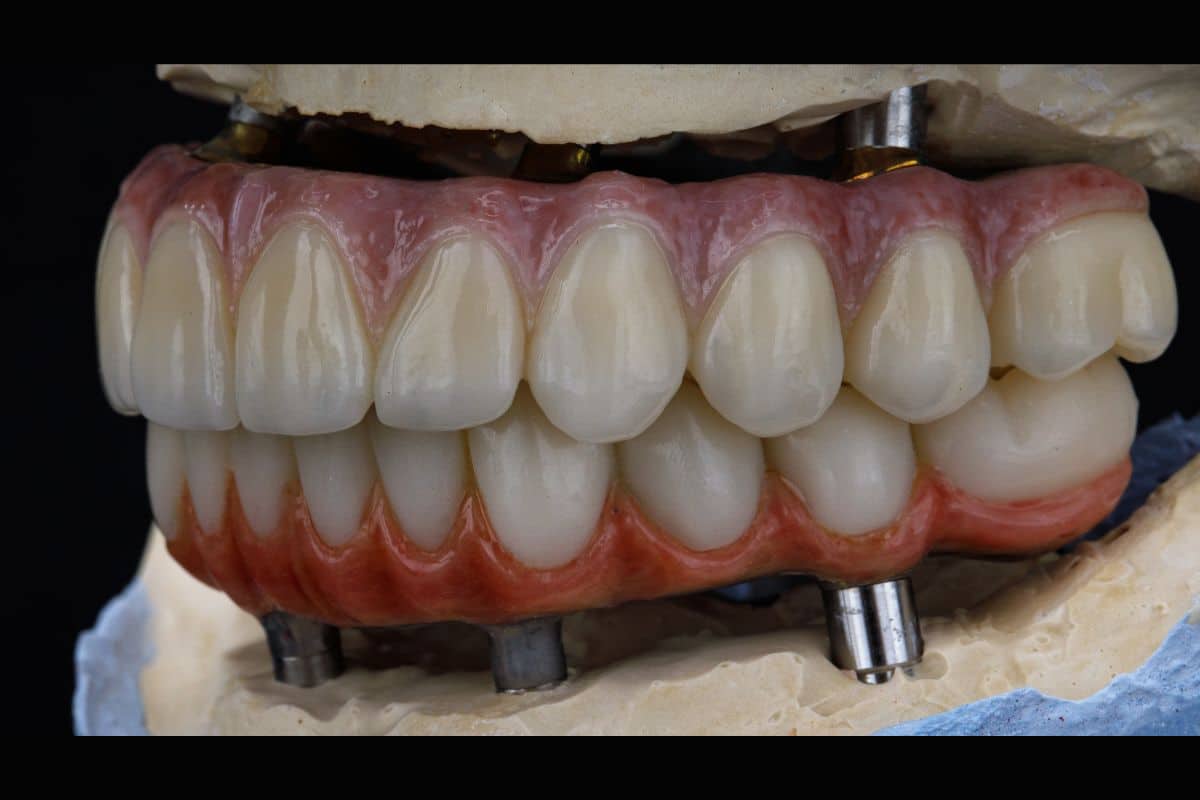 All on 4 Dental Implants