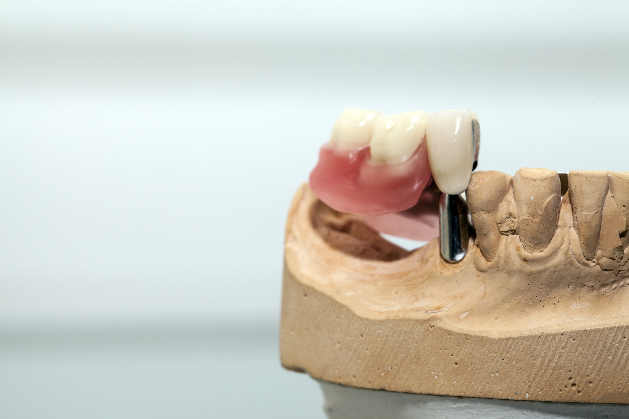 What to Do If Your Dental Implant Feels Loose?