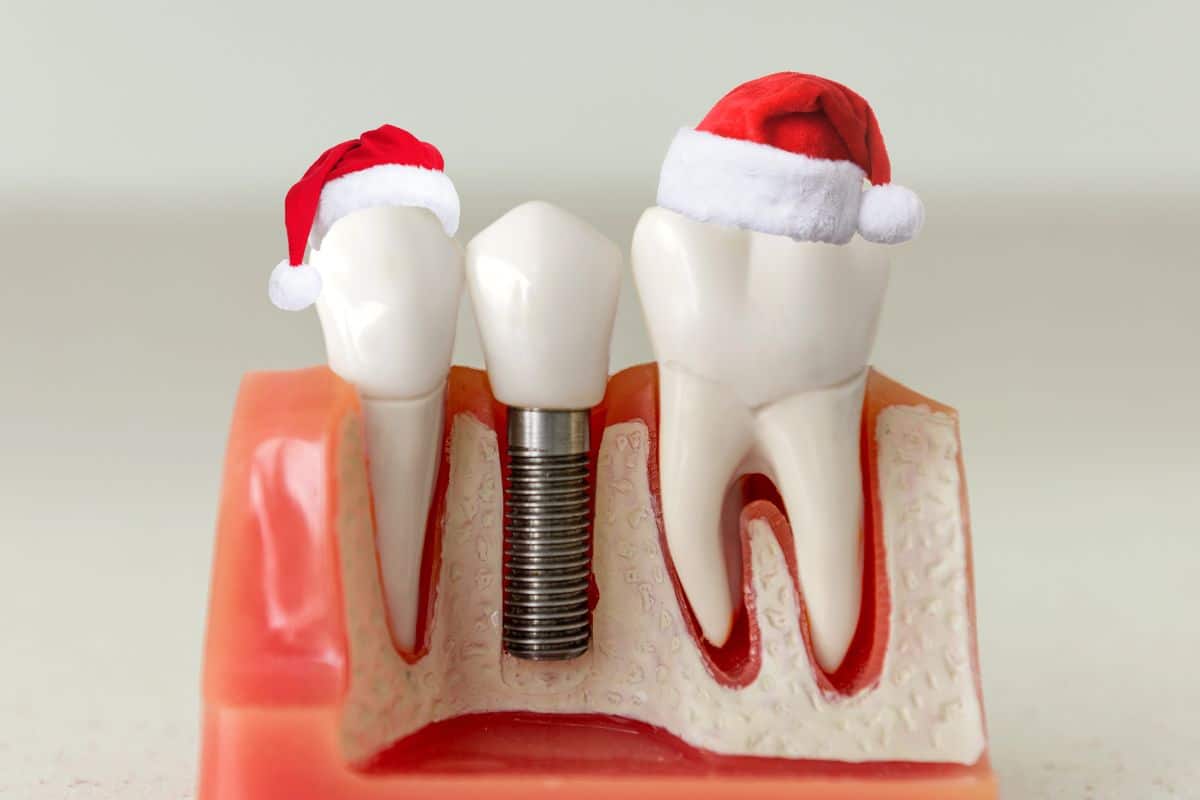 Dental Implants