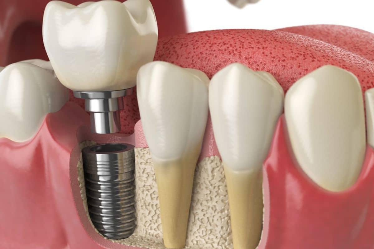 Dental Implants