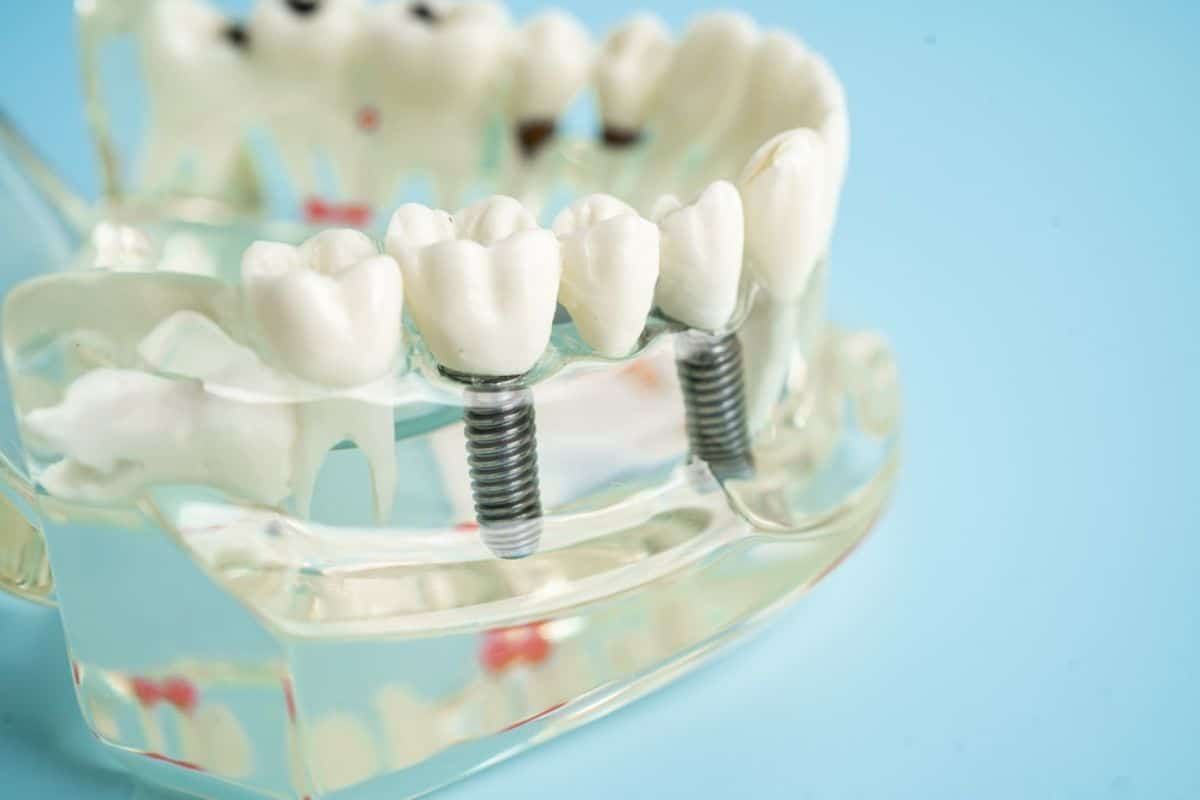Dental Implants for Molar Teeth