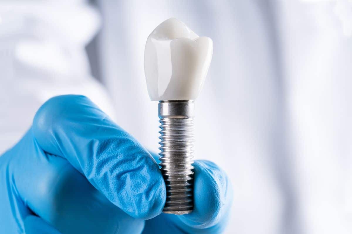 How Long Do Dental Implants Last