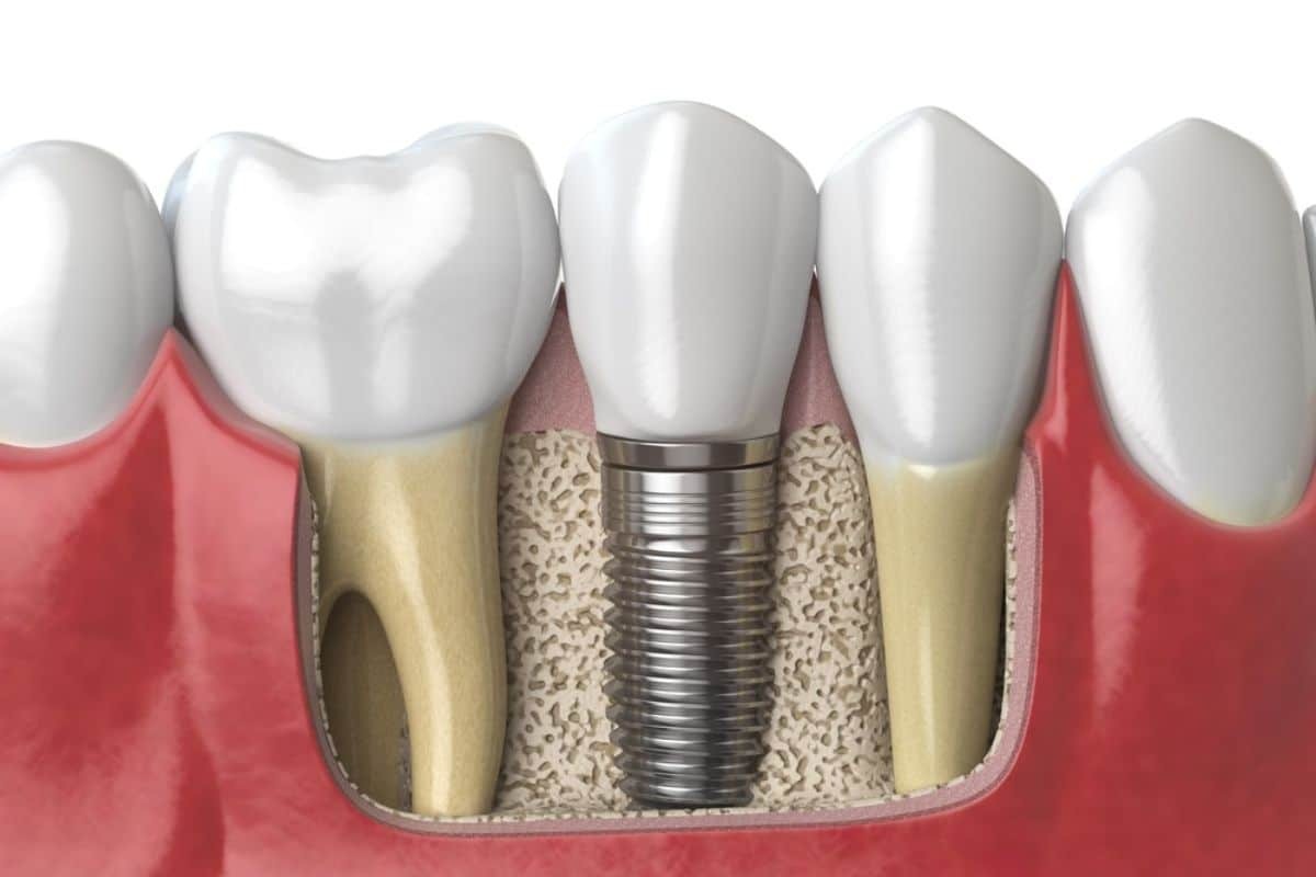 Implant dentist corpus christi