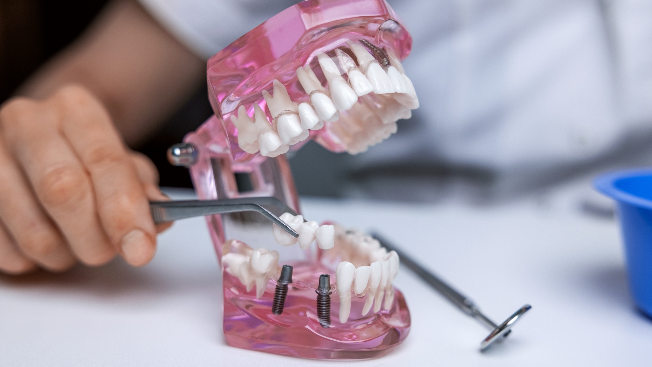 Implant Dentist Teams Collaborate for Restoration Success