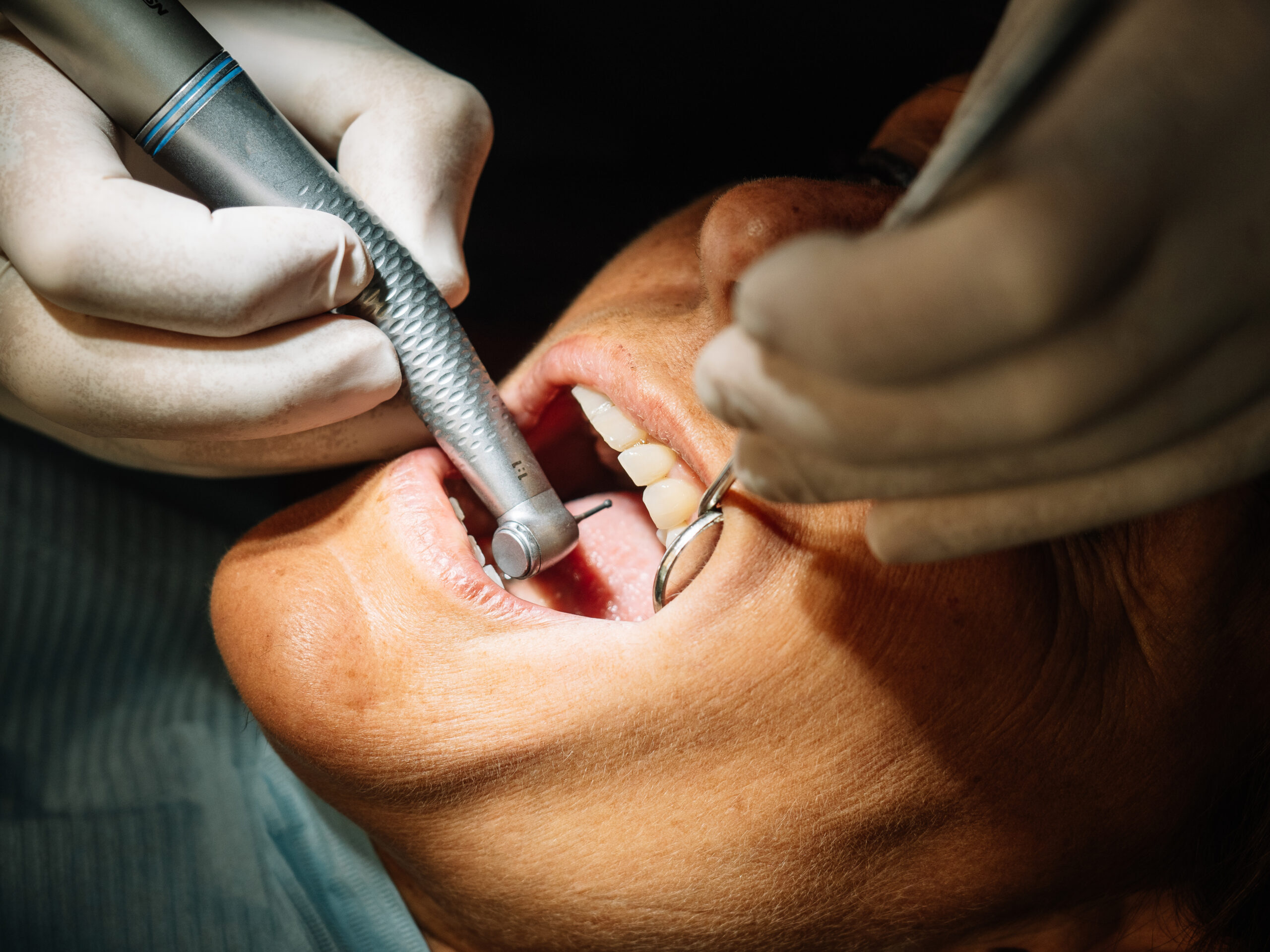 Wisdom Teeth Extraction: Local vs General Anesthesia