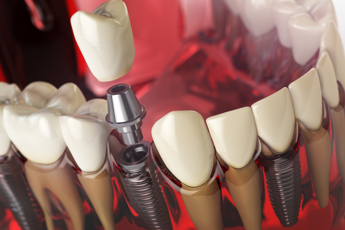 Featured image for “5 Lifestyle Changes That Help Your Dental Implants Last Longer”