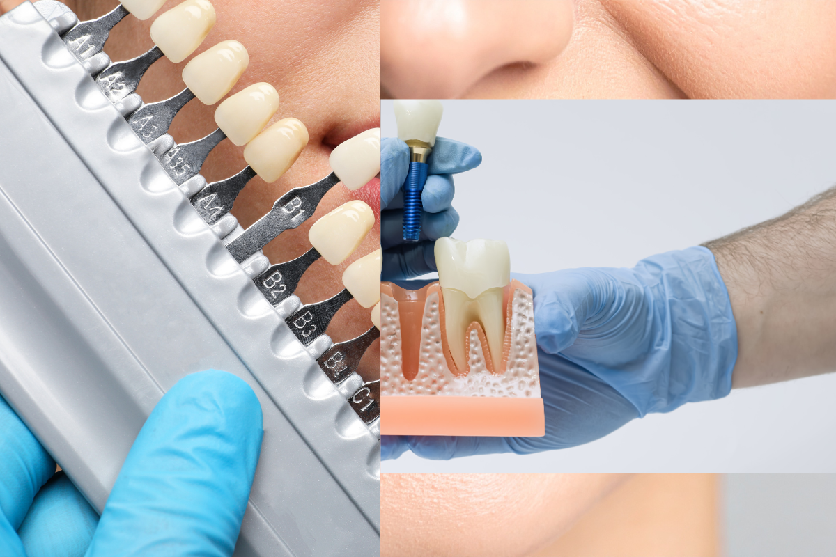Featured image for “Dental Implants and Cosmetic Dentistry: Creating Natural-Looking Smiles”